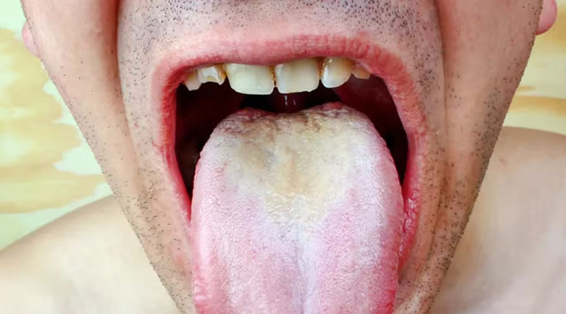Không vệ sinh lưỡi sau mỗi lần đánh răng sẽ khiến vi khuẩn sinh sôi tạo ra hợp chất sulfur dẫn đến hôi miệng