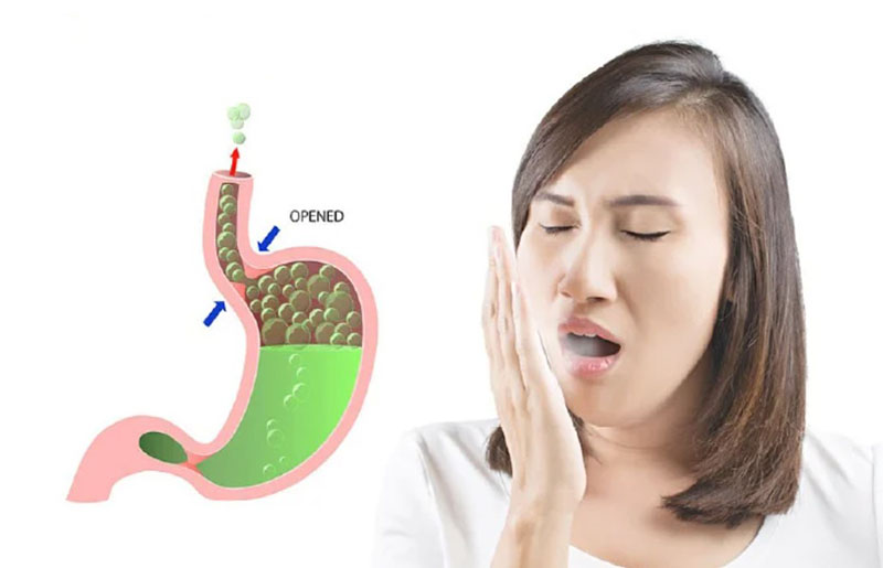 Phương pháp điều trị hơi thở có mùi hôi từ dạ dày hiệu quả Hơi thở có mùi đẩy lên từ dạ dày liên quan đến đường tiêu hóa khiến dịch vị trào ngược lên vòm họng