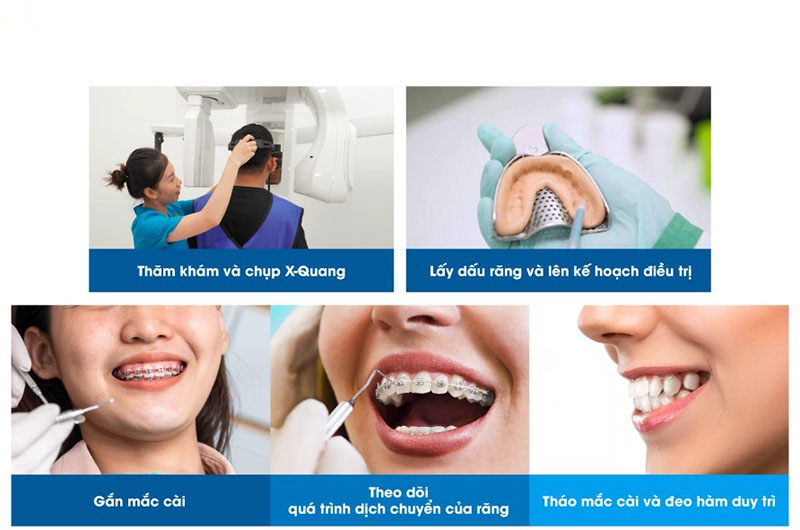 Tổng hợp các thông tin cần nhớ khi niềng răng ở Đức Quy trình thực hiện sẽ 6 bước cơ bản