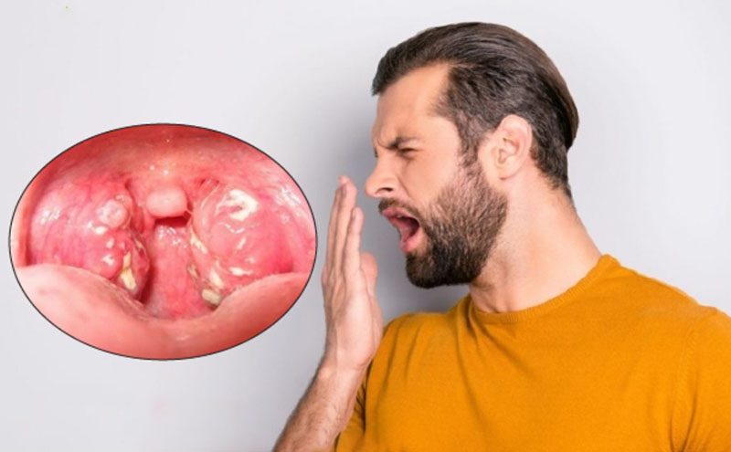 Nguyên nhân của viêm họng hạt gây hôi miệng và giải pháp Viêm họng hạt không điều trị kịp thời có thể dẫn đến những biến chứng khác, làm tăng mức độ hôi miệng