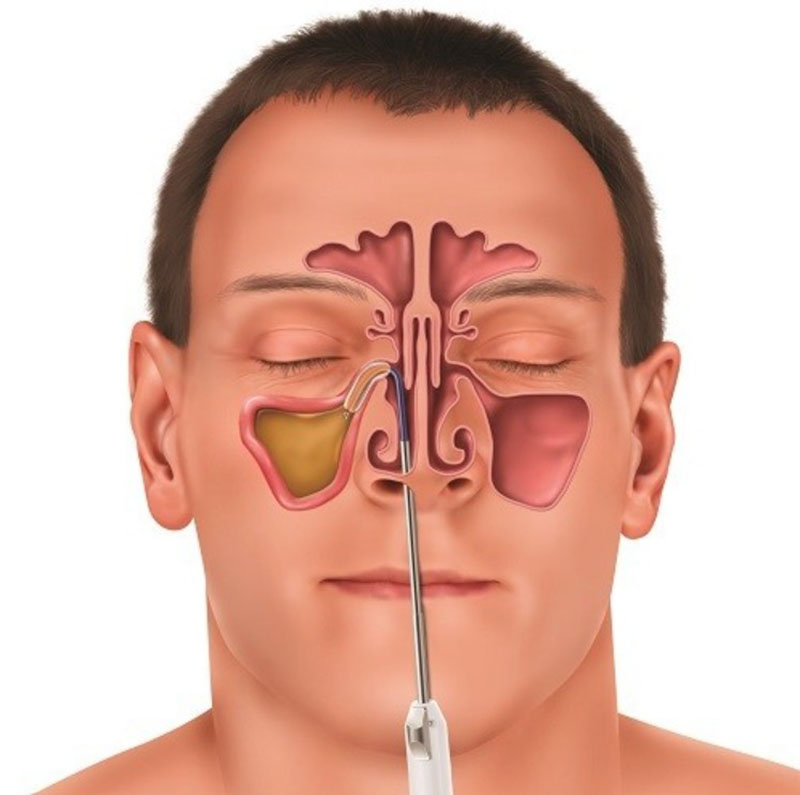 Nguyên nhân viêm xoang gây hôi miệng và cách khắc phục Bác sĩ sẽ chỉ định phẫu thuật khi việc dùng thuốc không hiệu quả