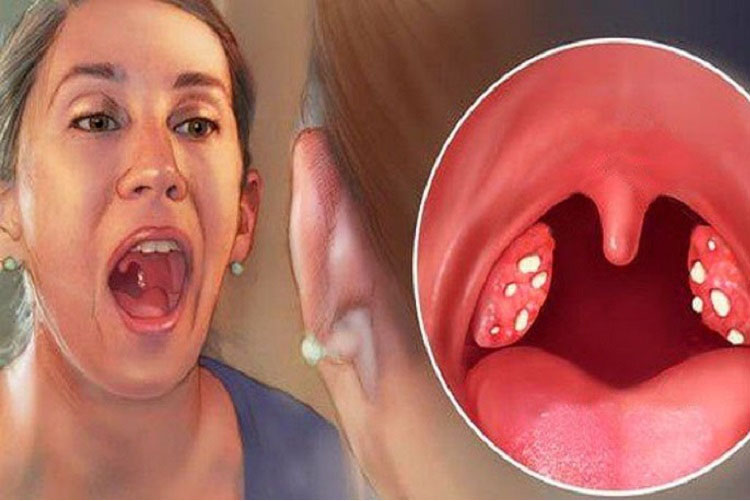 Cắt amidan có hết hôi miệng không? Lưu ý khi cắt amidan Viêm amidan là nguyên nhân thường gặp gây hôi miệng