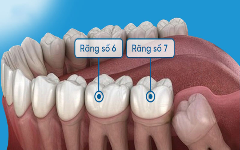 Những răng sữa nào không thay? Cách chăm sóc răng không thay Răng sữa không thay thường mọc sau cùng trên cung hàm