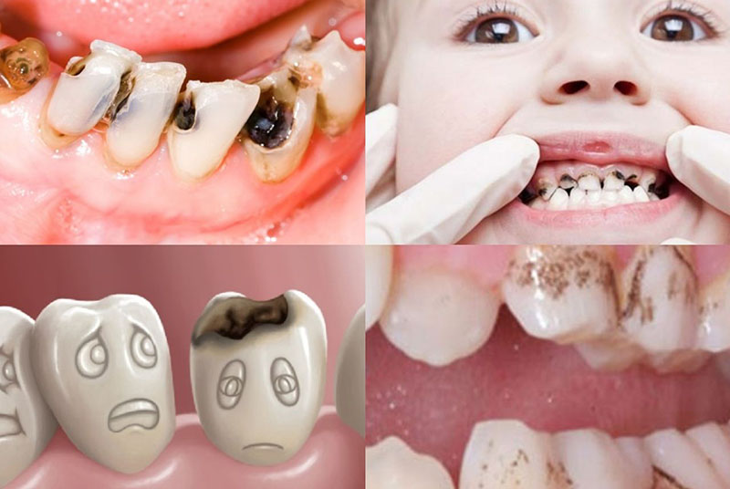 Những răng sữa nào không thay? Cách chăm sóc răng không thay Chăm sóc răng miệng không đúng dẫn đến nhiều hệ lụy liên quan đến bệnh lý răng miệng