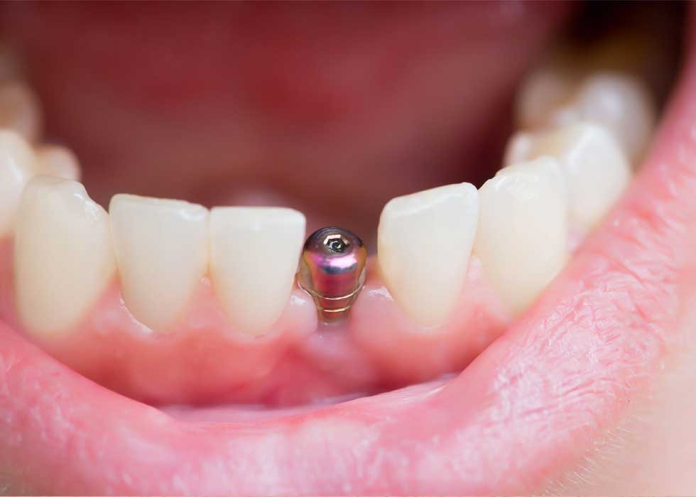 Gãy răng cửa có mọc lại không? Cách phục hình hiệu quả Cấy ghép Implant được đánh giá cao về tính thẩm mỹ và chức năng, độ tương thích sinh học cao, không gây kích ứng nướu