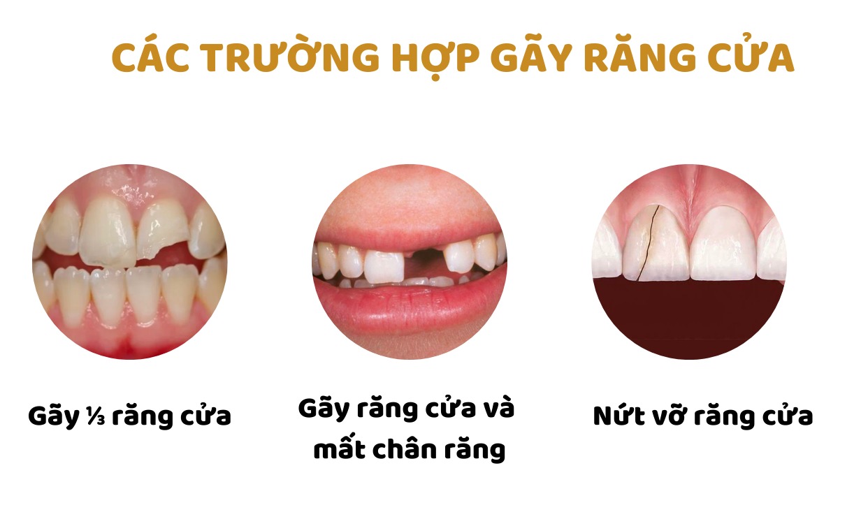Gãy răng cửa có mọc lại không? Cách phục hình hiệu quả Gãy răng cửa ảnh hưởng rất lớn đến thẩm mỹ và chức năng ăn nhai