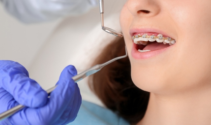 Răng cửa mọc lệch: Nguyên nhân và cách khắc phục Niềng răng là phương pháp nắn răng lệch an toàn, lành tính