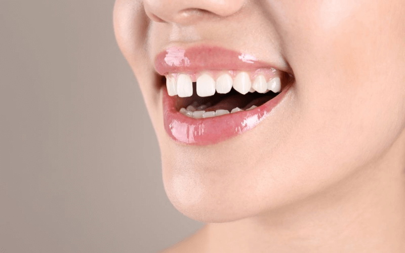 Những ảnh hưởng của răng cửa thưa và cách giải quyết Răng cửa thưa gây mất thẩm mỹ và ảnh hưởng đến khả năng nhai