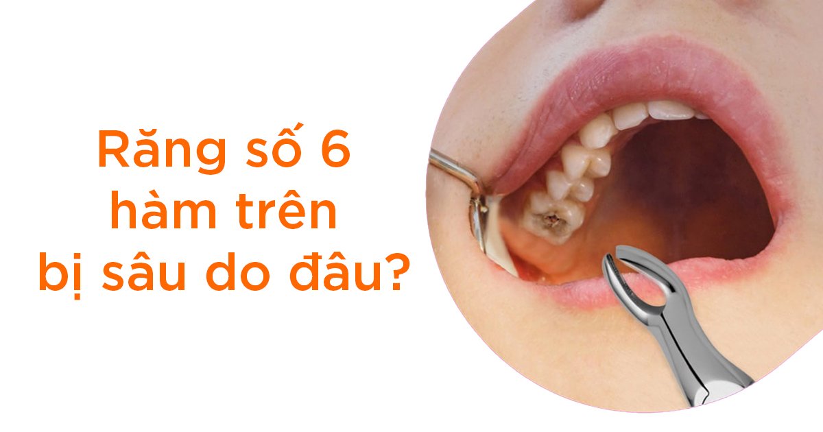 Răng số 6 bị sâu vỡ có sao không? Cách xử lý nhanh, an toàn Răng số 6 bị sâu vỡ không chỉ ảnh hưởng đến hoạt động ăn uống thường ngày mà còn làm tăng nguy cơ mắc các bệnh lý về răng miệng
