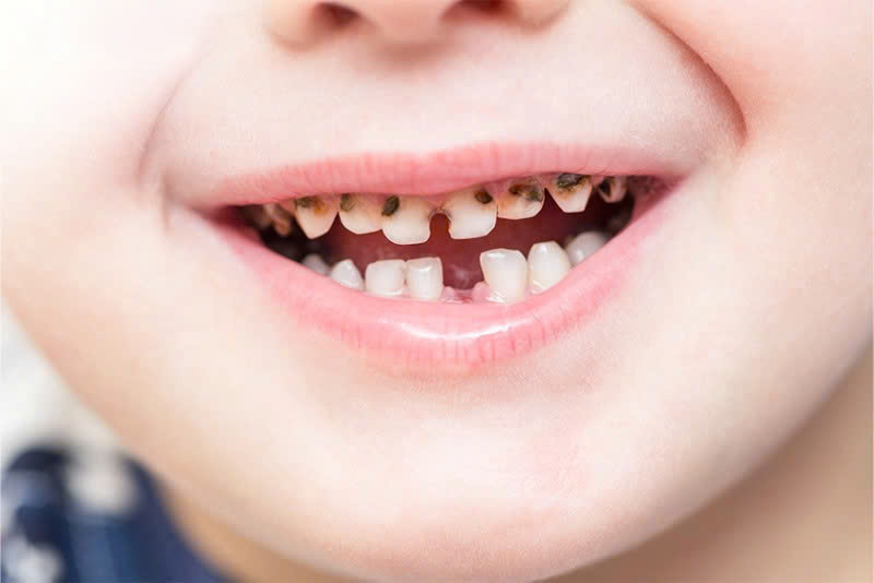 Nguyên nhân răng sữa bị sâu và hướng dẫn xử lý đúng cách Theo các thống kê từ Viện Răng hàm mặt quốc gia, tỷ lệ trẻ Việt Nam mắc bệnh sâu răng ngày một gia tăng ở mức báo động