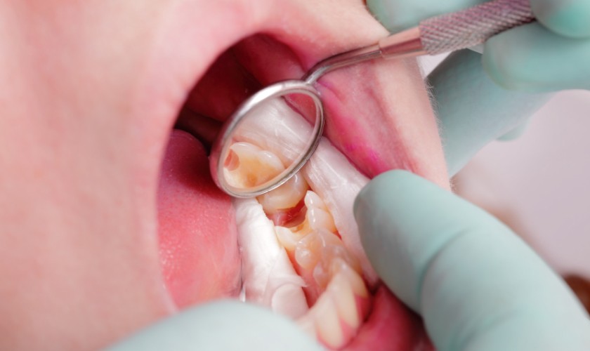 Sâu răng có mủ: Dấu hiệu nguy hiểm cảnh báo nhiễm trùng răng miệng Bác sĩ sẽ điều trị sâu răng dựa trên tình trạng, mức độ bệnh với phác đồ phù hợp nhất