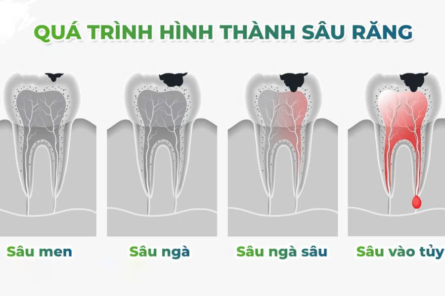 7 Cách trị sâu răng vĩnh viễn tại nhà đơn giản, an toàn Cần xem xét các giai đoạn phát triển của sâu răng, từ đó nhận biết xem khi nào có thể tự điều trị tại nhà