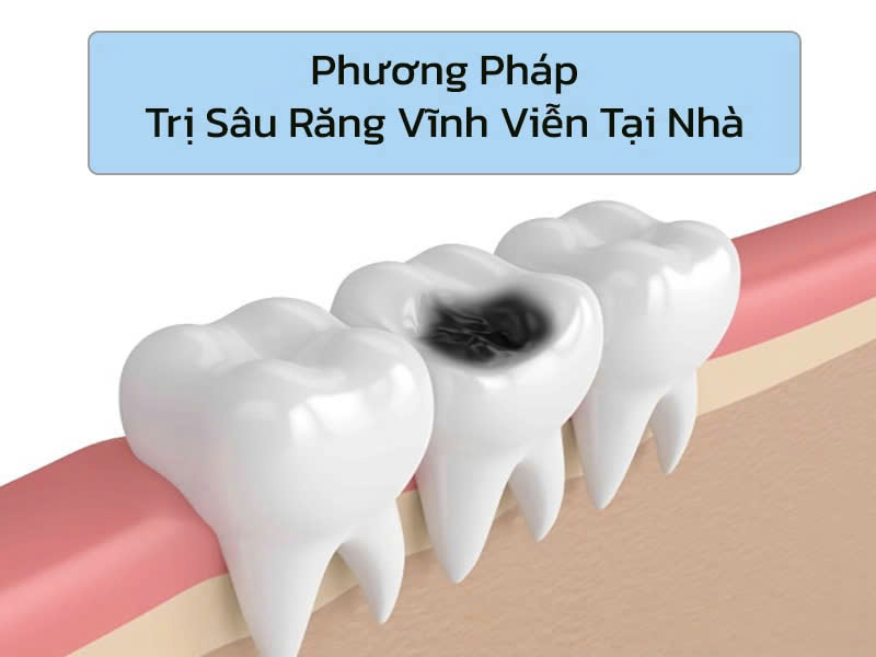 7 Cách trị sâu răng vĩnh viễn tại nhà đơn giản, an toàn Trị sâu răng vĩnh viễn tại nhà nghe có vẻ khó tin nhưng lại hoàn toàn khả thi