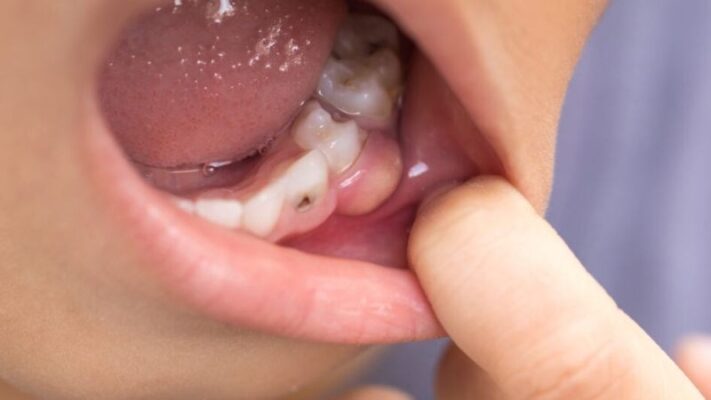 Áp xe nướu là hiện tượng nướu có túi mủ nhỏ