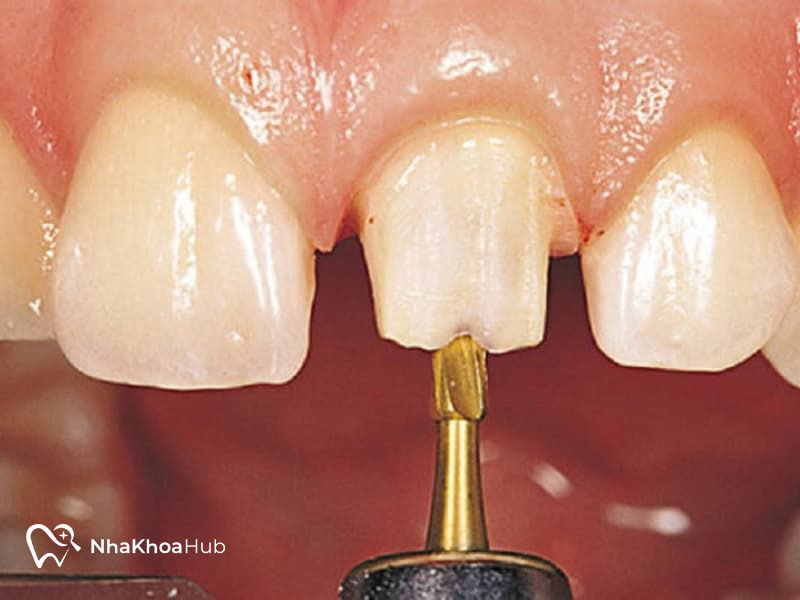 Chi phí mài răng cửa bao nhiêu tiền? Có đắt không? Mài cùi răng cửa được nhiều nha khoa sử dụng hiệu quả