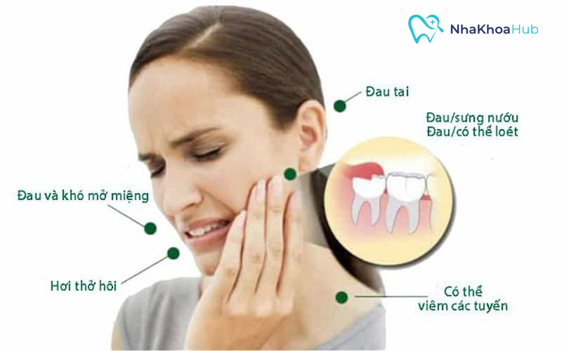 Mọc thêm răng hàm dưới có nguy hiểm không? Dấu hiệu nhận biết Mọc răng khôn hàm dưới ảnh hưởng tiêu cực tới đời sống người bệnh