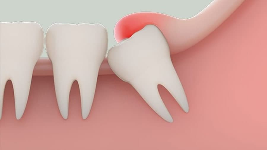 Ngứa nướu ở chân răng là triệu chứng ban đầu khi khởi phát viêm nướu - bệnh lý do vệ sinh răng miệng kém gây nên