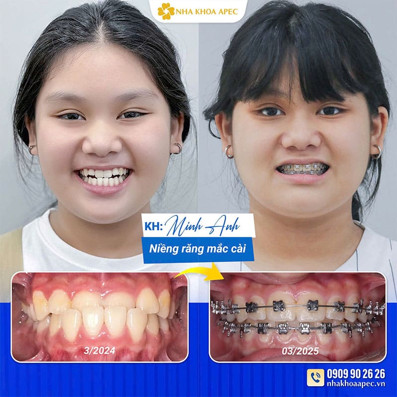 Nha khoa Apec - Địa chỉ chăm sóc răng miệng uy tín, chất lượng Quá trình trước và sau chỉnh nha của Minh Anh