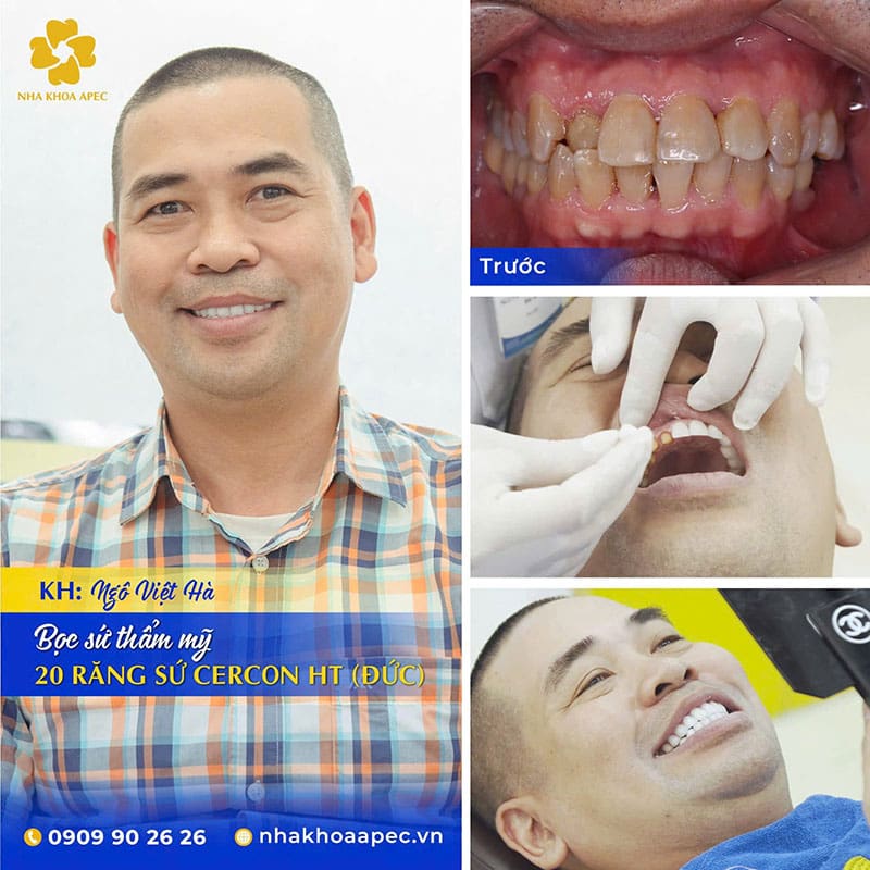 Nha khoa Apec - Địa chỉ chăm sóc răng miệng uy tín, chất lượng Hàm răng trắng sáng, khác biệt rõ rệt của anh Việt Hà
