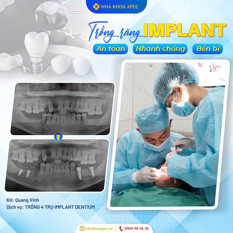 Nha khoa Apec - Địa chỉ chăm sóc răng miệng uy tín, chất lượng Cắm Implant đảm bảo khả năng ăn nhai của khách hàng