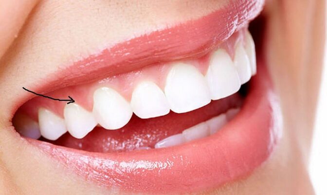 Nướu răng là phần mô bao quanh chân răng, xương ổ và cổ răng