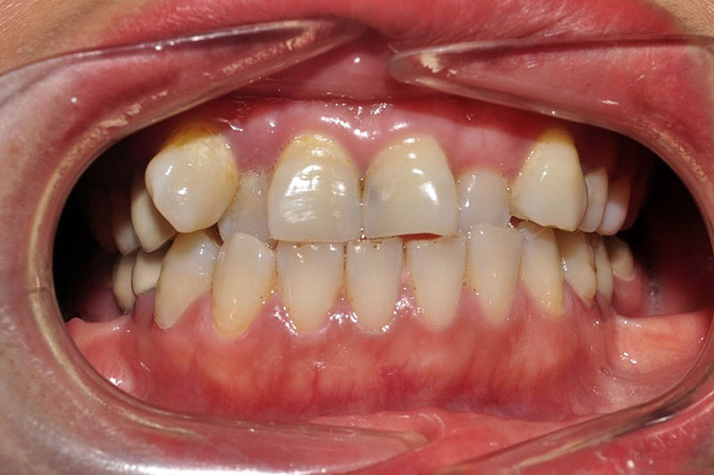 Răng 9630 là gì? Giải thích ý nghĩa và cách khắc phục hiệu quả Răng 9-6-3-0 vừa gây mất thẩm mỹ vừa ảnh hưởng đến chức năng ăn nhai.