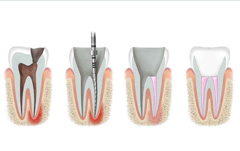 Nguyên nhân làm cho răng cửa bị đen và hướng xử lý Quá trình lấy tủy sẽ loại bỏ hết phần sâu và lấp đầy bằng loại vật liệu chuyên biệt