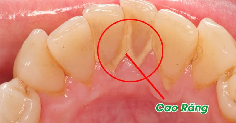 Nguyên nhân răng hàm bị đen và cách điều trị dứt điểm Đến nha khoa lấy cao răng 6 tháng/lần
