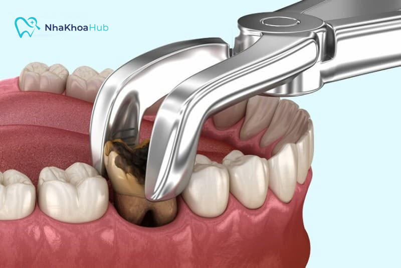 Nguyên nhân và cách xử lý khi răng hàm bị lung lay Răng bị sâu sẽ lan xuống tủy răng gây viêm nhiễm mô tủy và áp xe chân răng