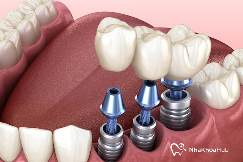 Nguyên nhân răng hàm dưới bị đổ vào trong và cách khắc phục Phần trụ implant sẽ kích thích xương hàm phát triển