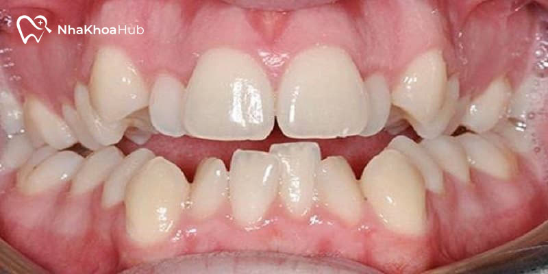 Răng hàm dưới mọc lệch vào trong có sao không? Giải đáp ngay Răng hàm dưới mọc lệch do thói quen đẩy lưỡi