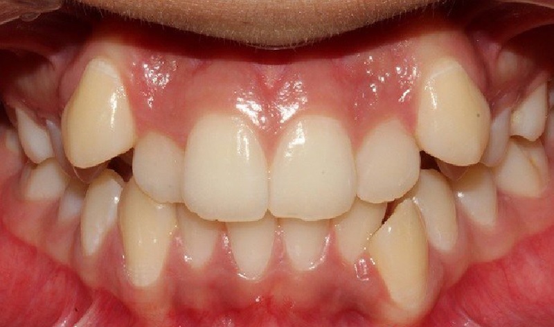 Răng khấp khểnh tướng số thế nào? Chi tiết về đường tài lộc Răng khấp khểnh ẩn chứa nhiều điều về tính cách và vận mệnh của người đó