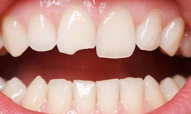 Mẻ răng: Nguyên nhân và cách khắc phục hiệu quả Răng cửa bị mẻ là trường hợp phổ biến, do chúng có vị trí trung tâm