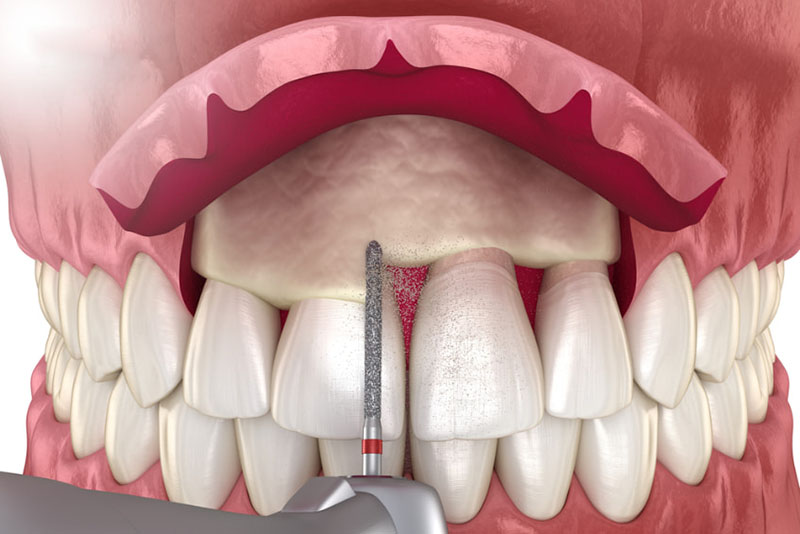 Người có răng ngắn cười hở lợi tướng số thế nào? Cách điều chỉnh Phẫu thuật cắt bớt lợi thừa cải thiện hiệu quả cho mọi mức độ