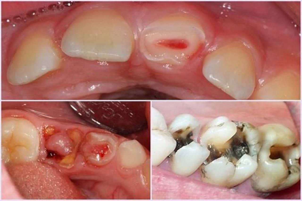 Răng sâu lồi thịt: Biến chứng nguy hiểm & cách điều trị triệt để Răng sâu lồi thịt là tình trạng sâu răng đáng báo động gây đau nhức và viêm nhiễm