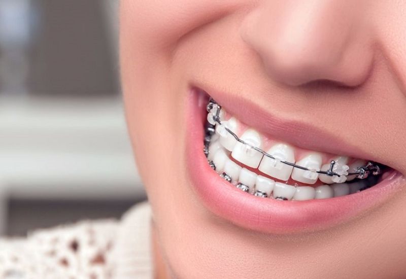 Quy trình niềng răng gồm 5 bước giúp răng ổn định không bị chạy 