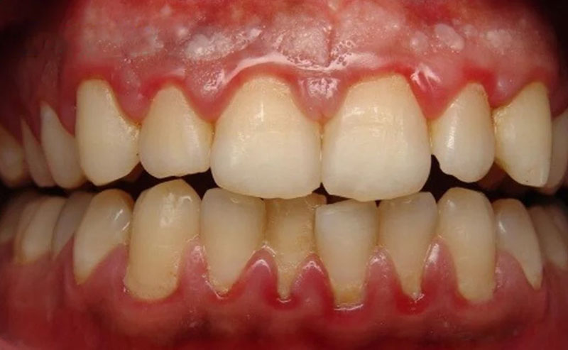 Nhiễm trùng nặng sẽ làm xuất hiện mủ hoặc túi mủ quanh răng cửa