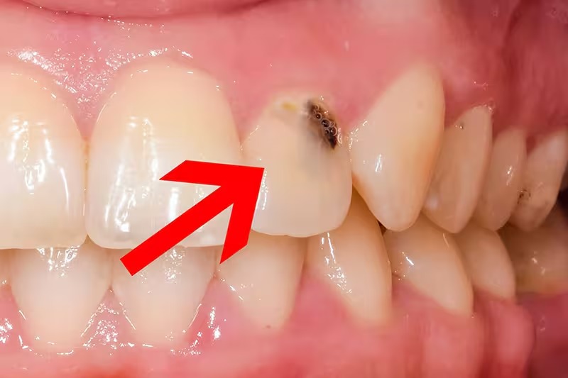 Tẩy trắng răng có làm răng yếu đi không? Giải đáp chuẩn y khoa Khi bị sâu răng, viêm nướu cần điều trị trước khi tẩy trắng răng