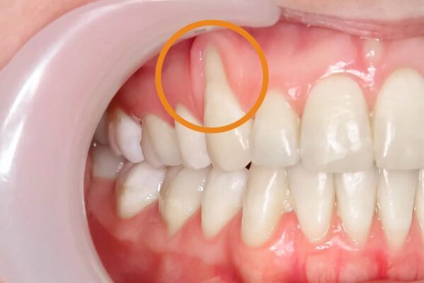 Tụt nướu răng làm lộ chân răng, khiến phần chân răng dễ bị nhiễm trùng, sâu răng dẫn đến mất răng