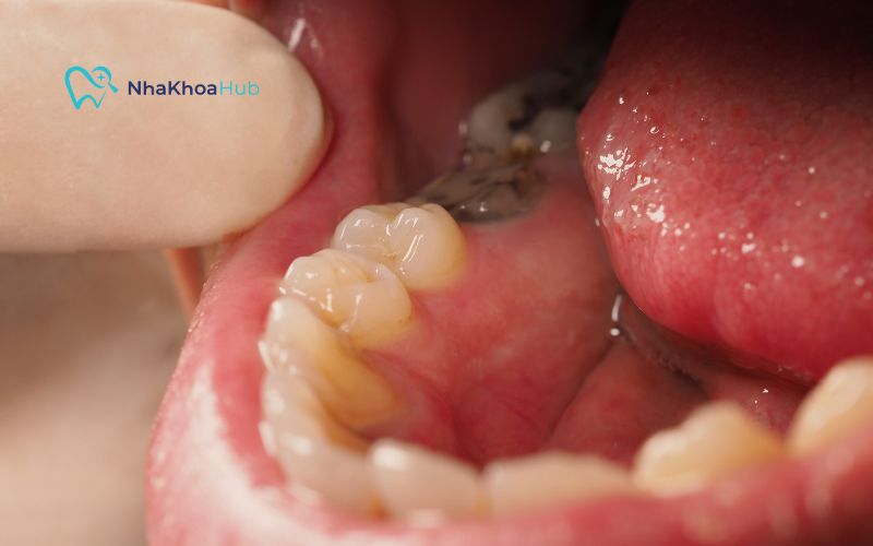 Nhổ răng sâu đang đau sẽ có nguy cơ nhiễm trùng lan rộng, gây khó khăn trong việc lành vết thương