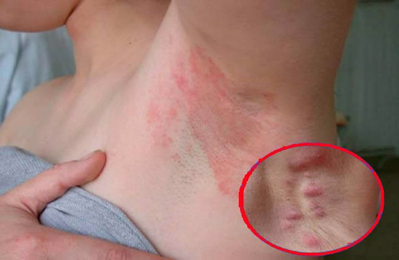 Cách làm hết lông nách bằng kem đánh răng hiệu quả tại nhà Tránh tẩy lông khi vùng da dưới cánh tay có vết thương hoặc kích ứng