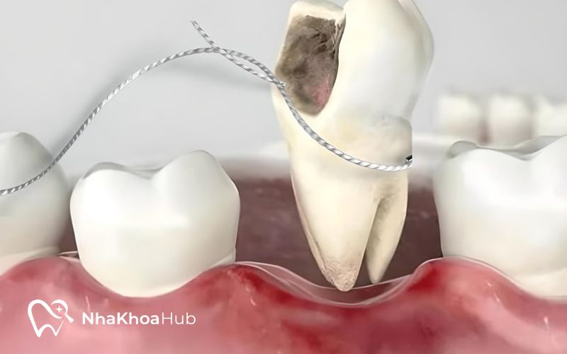 Nhổ răng hàm bị sâu tại nhà nhanh chóng, tiết kiệm chi phí và không mất thời gian đi lại