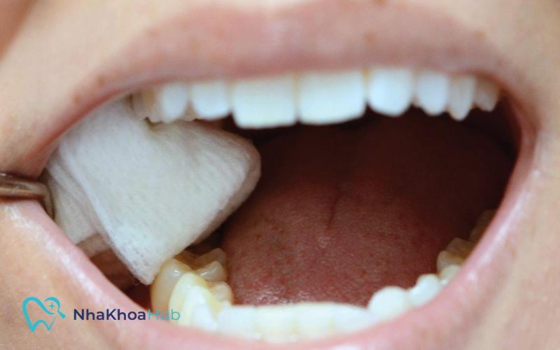 Cắn chặt miếng gạc và giữ nguyên trong khoảng 45-60 phút để cầm máu 