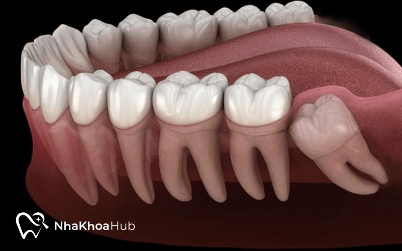 Răng khôn có cấu trúc phức tạp và nằm sâu trong hàm không nên tự nhổ tại nhà