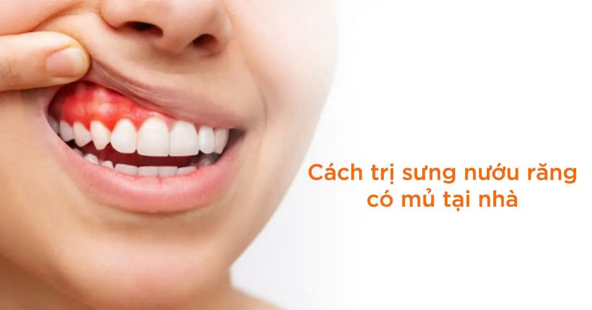 Tiết lộ các cách trị sưng nướu răng có mủ tại nhà hiệu quả Điều trị sưng nướu răng có mủ tại nhà đơn giản mà hiệu quả, giúp bạn giảm đau và ngăn ngừa biến chứng