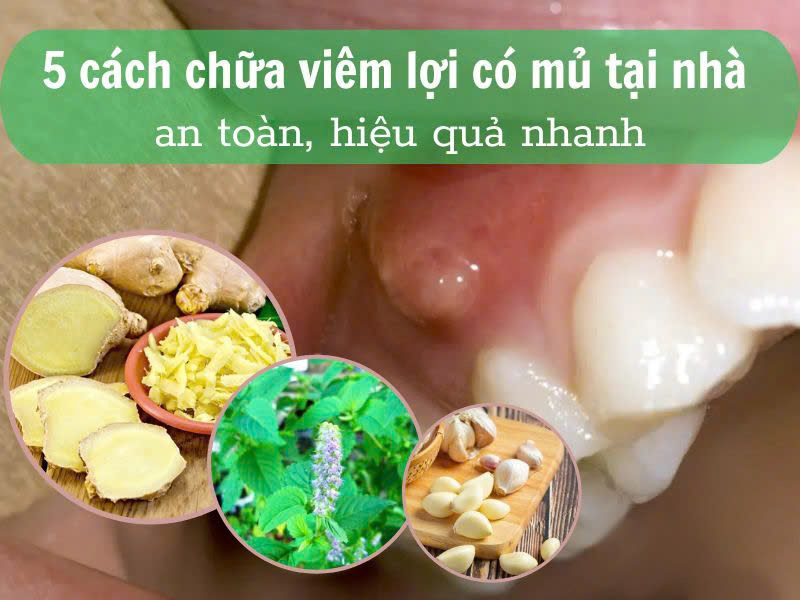 Tiết lộ các cách trị sưng nướu răng có mủ tại nhà hiệu quả Trước và sau khi điều trị tại nha khoa, bạn có thể áp dụng các cách trị sưng nướu răng có mủ tại nhà