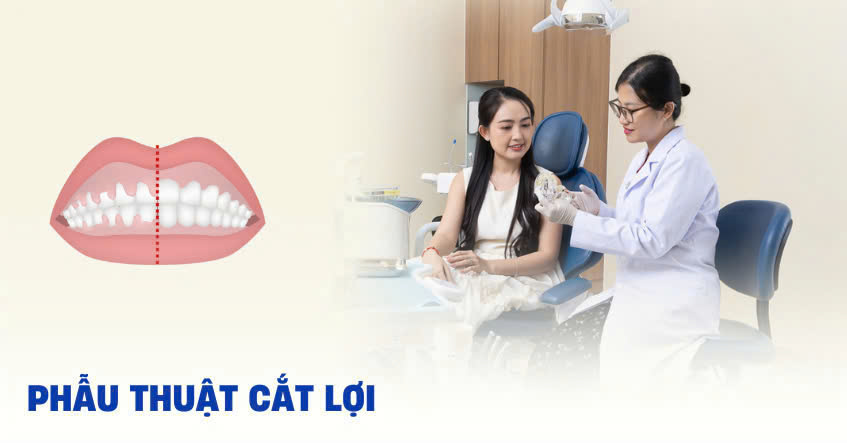 Cắt nướu có đau không? Các phương pháp phẫu thuật cắt nướu Cắt nướu răng là một thủ thuật thẩm mỹ đơn giản, được chỉ định khi người bệnh muốn loại bỏ nướu thừa hoặc phần viêm nhiễm