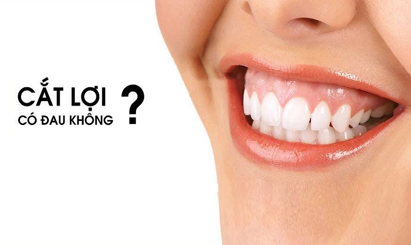 Cắt nướu có đau không? Các phương pháp phẫu thuật cắt nướu Thủ thuật cắt lợi nhằm mục đích loại bỏ một phần nướu ra khỏi khu vực phía trong và xung quanh răng
