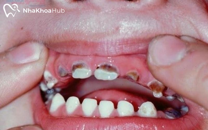 Chi phí nhổ răng sâu có bảo hiểm y tế có được hỗ trợ không? Nhổ bỏ răng do tai nạn hoặc tổn thương, ngăn chặn viêm nhiễm tổn hại răng khác