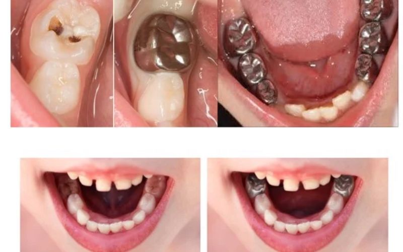 Lắp mão thép kim loại cho con đã trở thành lựa chọn hàng đầu của nhiều bậc cha mẹ